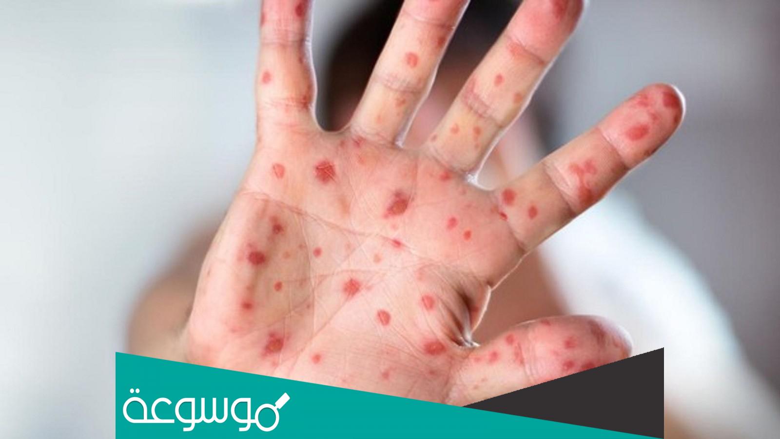 هل جدري القرود معدي