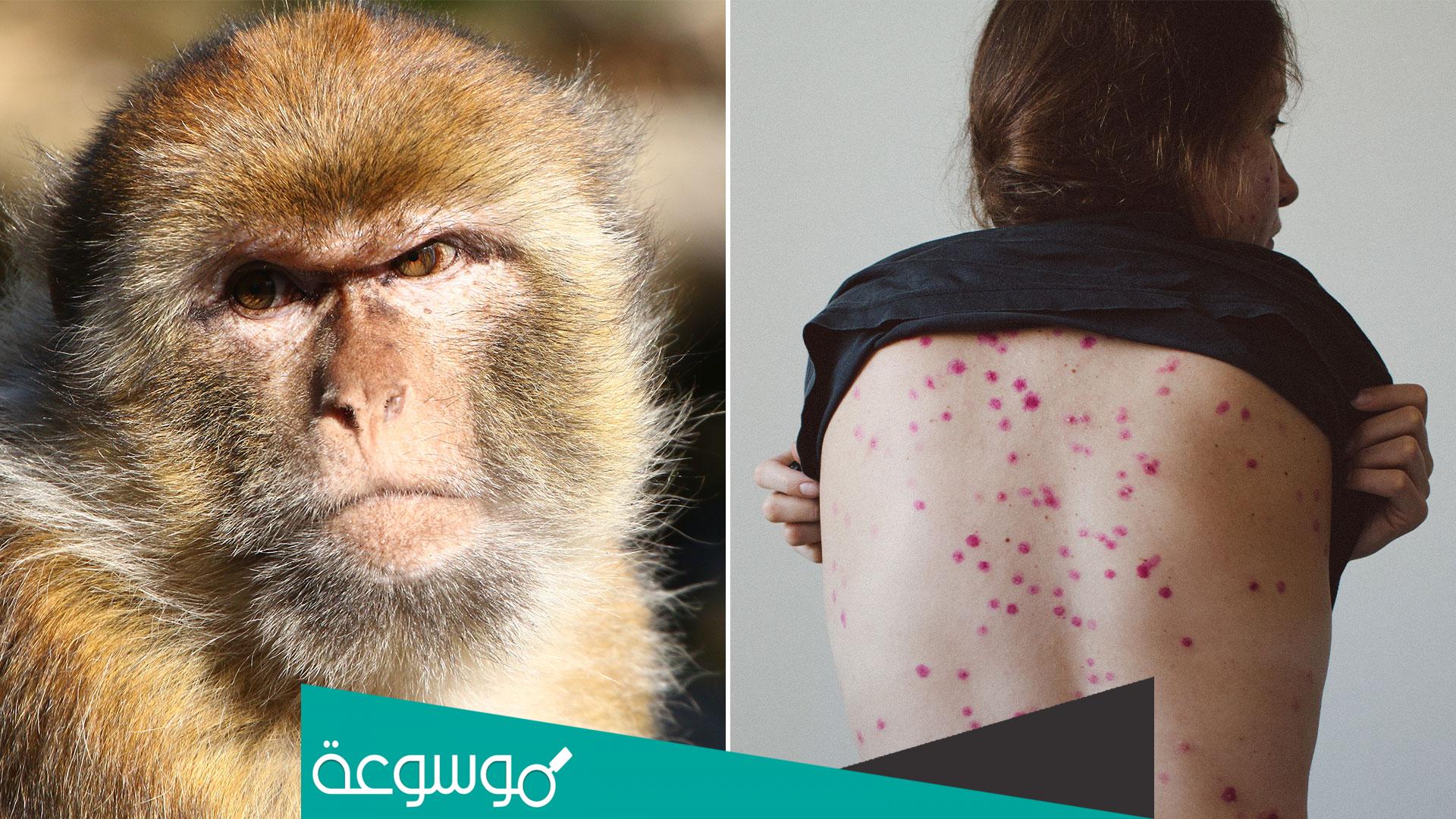 هل يوجد جدري القرود في الامارات ؟