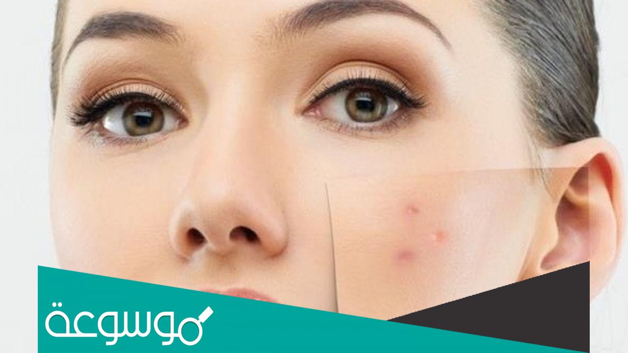 أسباب ظهور الحبوب المؤلمة في الوجه وعلاجها