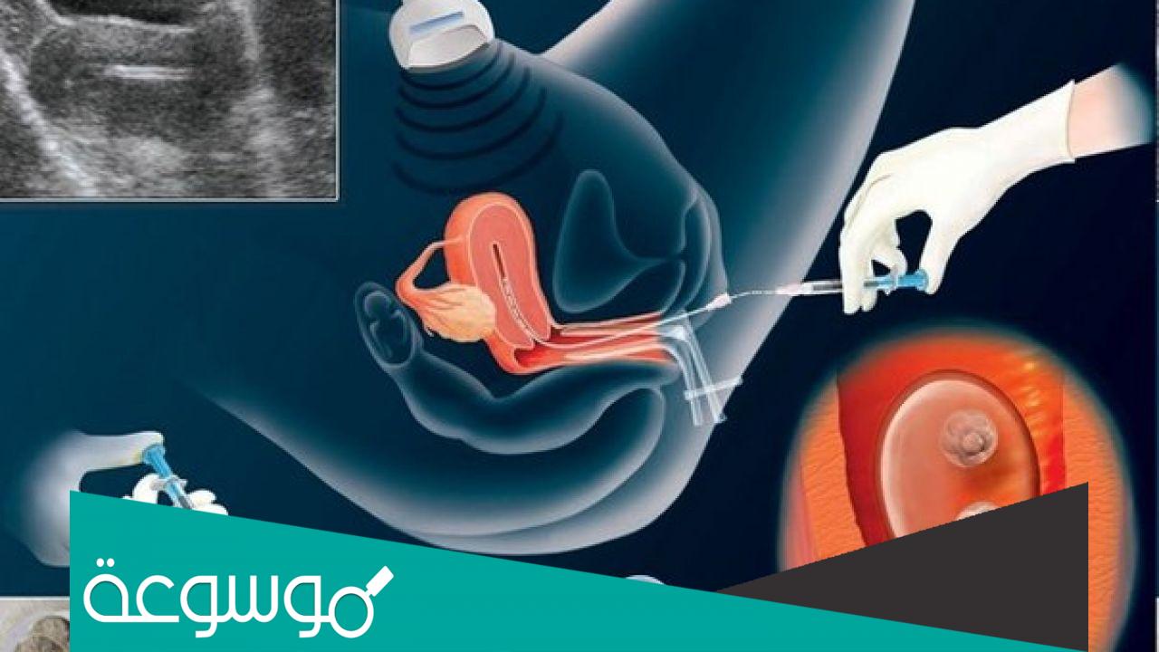 اسعار الحقن المجهري في مستشفي الامم