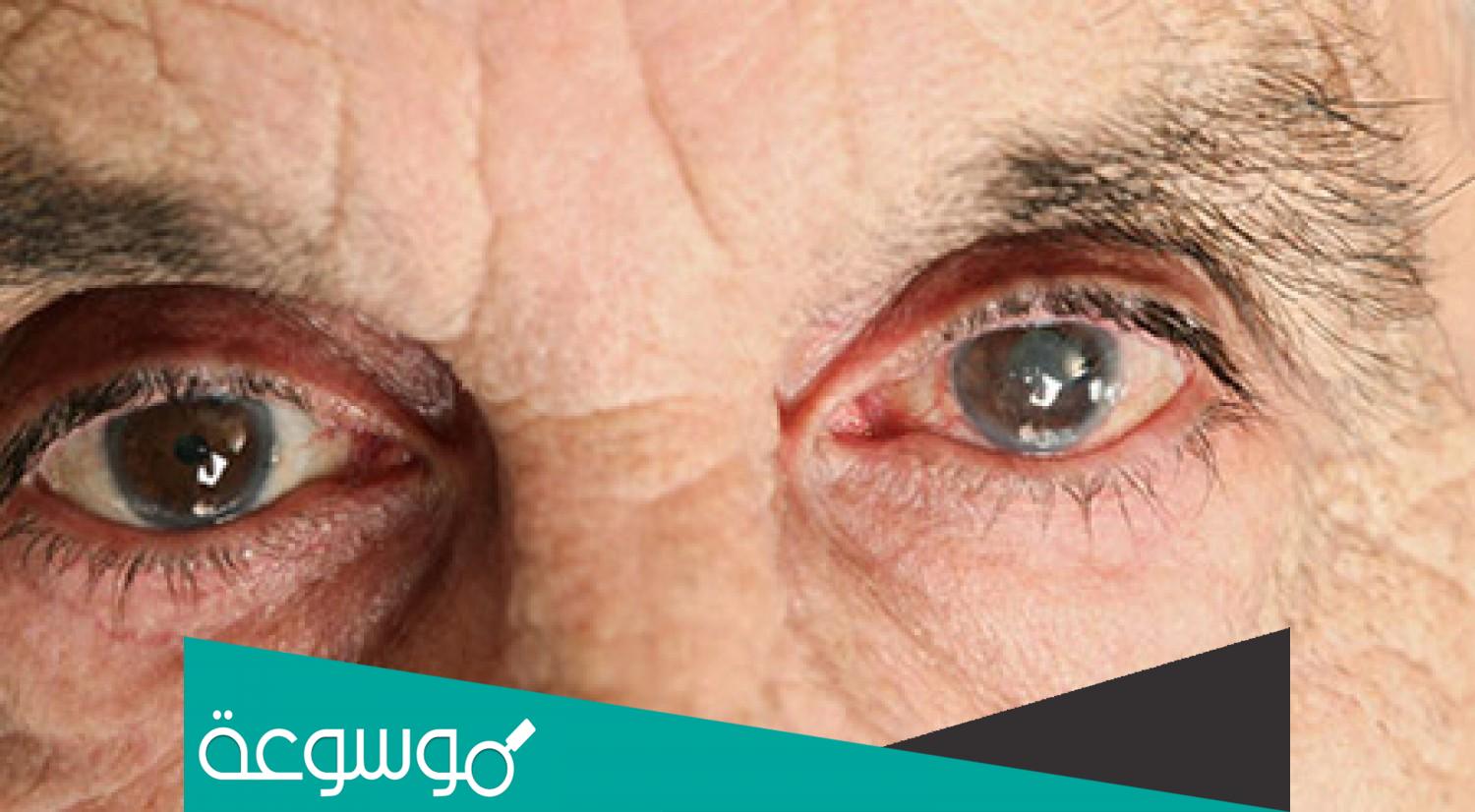 المياه البيضاء في العين بالانجليزي