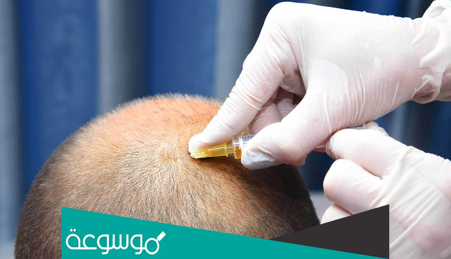 تجربتي مع حقن البلازما للشعر للرجال مضمون