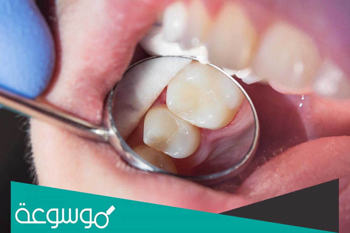 حشوة أسنان تباع في الصيدلية النهدي