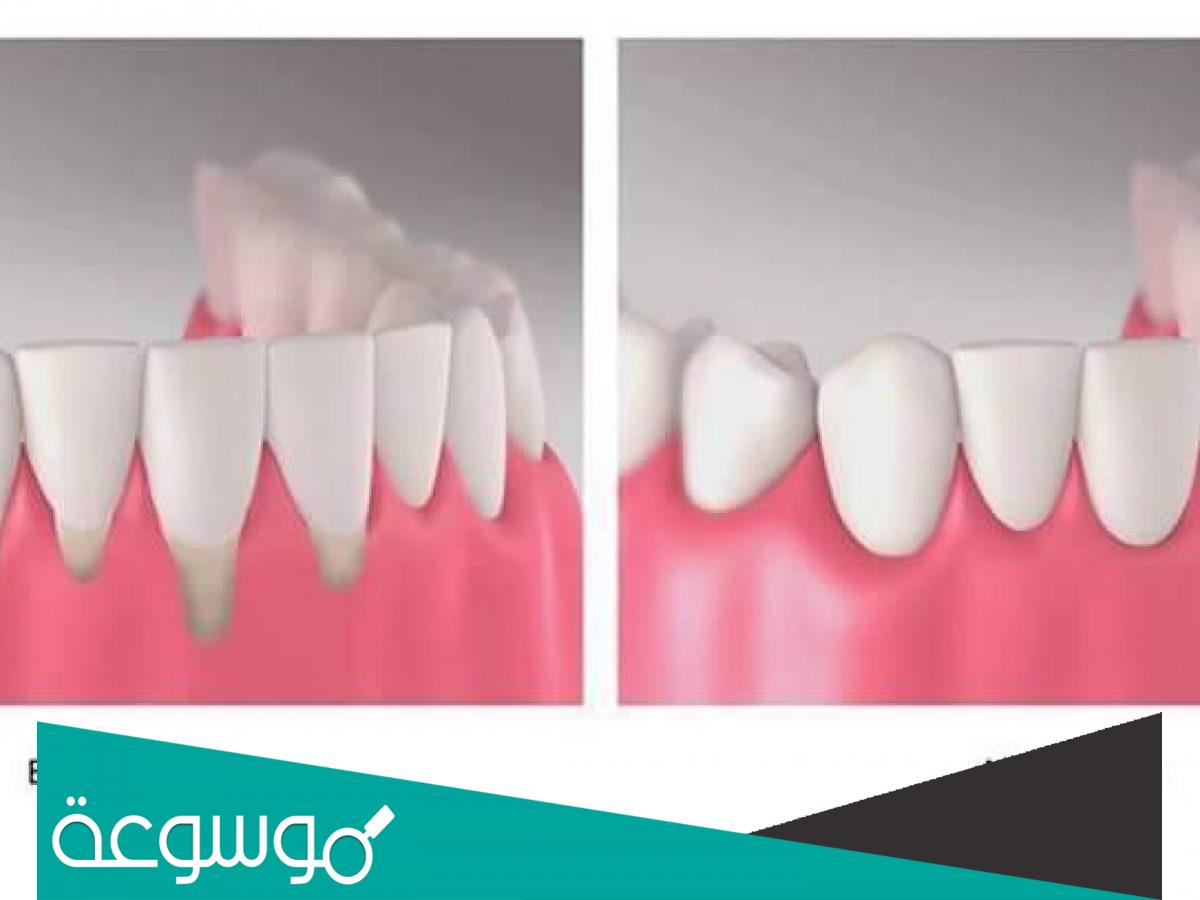 خطوات قص اللثة بالليز والنتائج والتكلفة