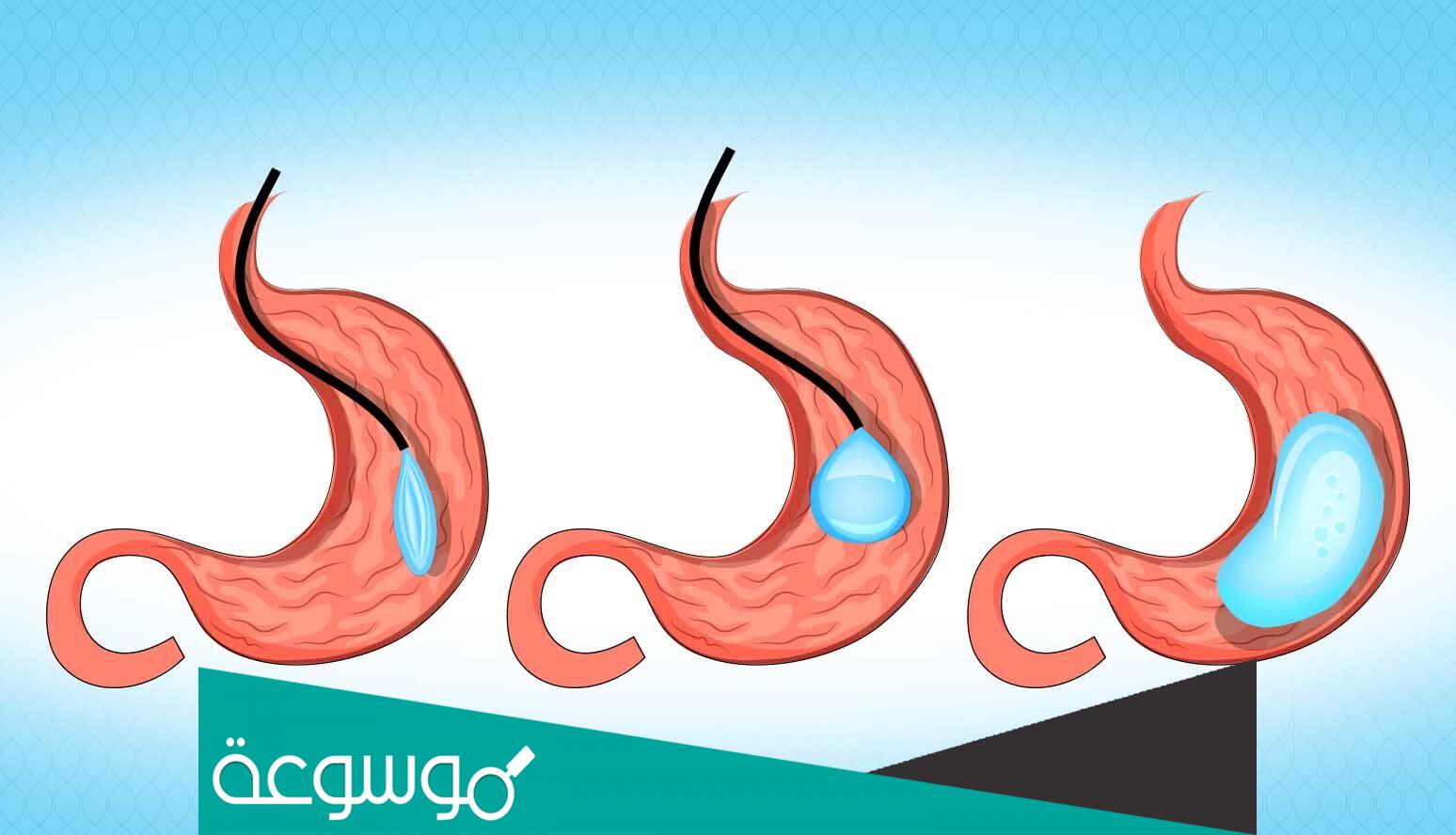 كبسولة بالون المعدة في السعودية | الأنواع والأسعار