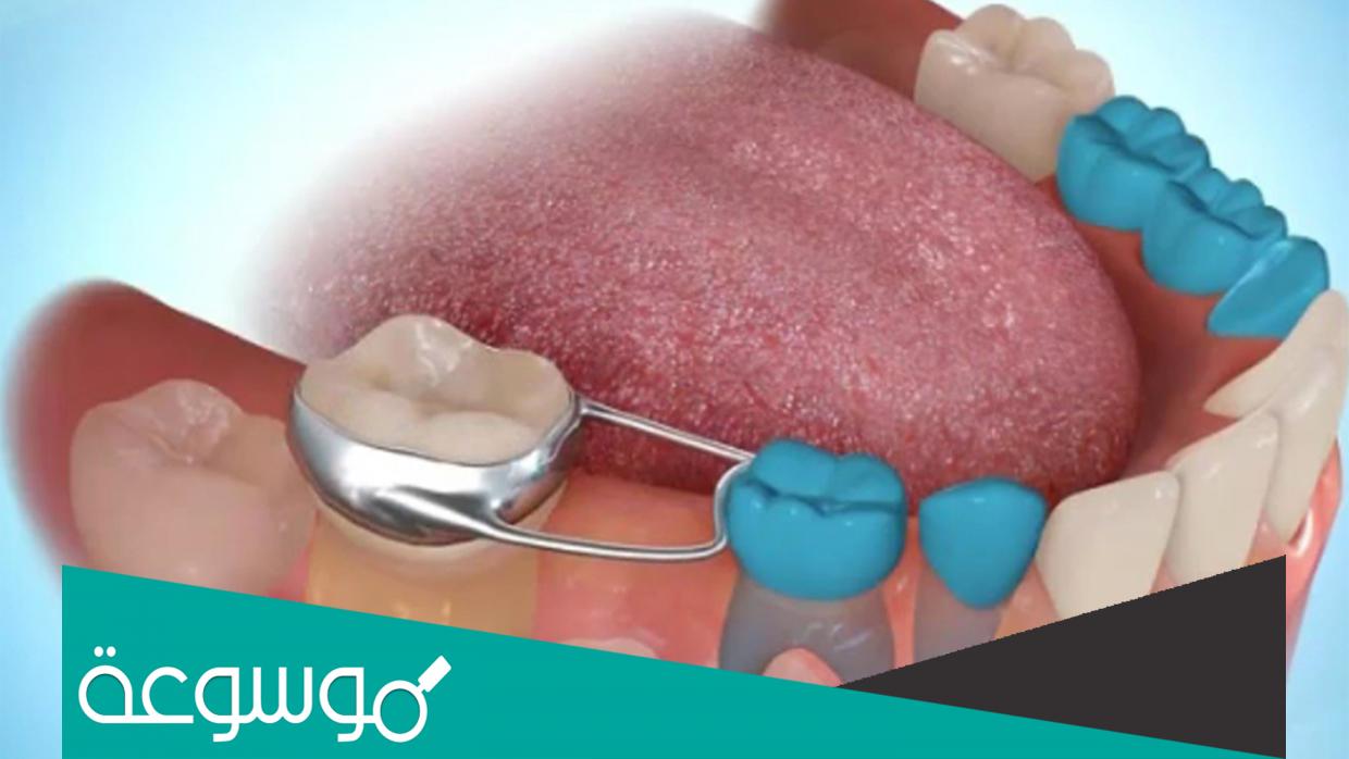 كم تكلفة زراعة الاسنان في المهيدب