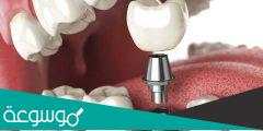 كم تكلفة  عملية زراعة الأسنان بالخطوات والصور