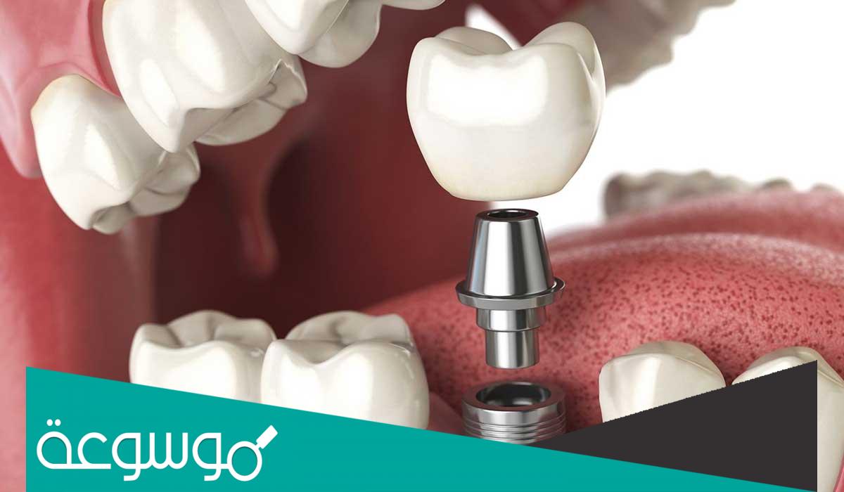 كم تكلفة عملية زراعة الأسنان