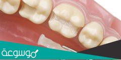 كم سعر حشوة الأسنان الدائمة | الانواع والمميزات