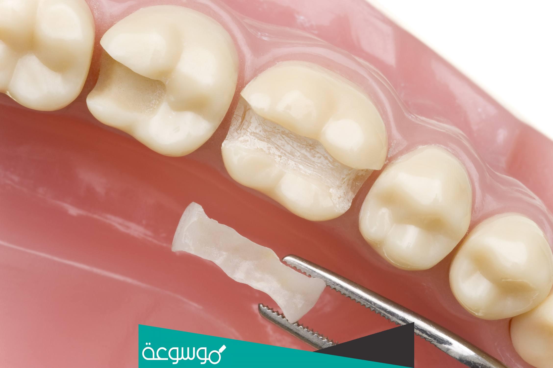 كم سعر حشوة الأسنان الدائمة | الانواع والمميزات