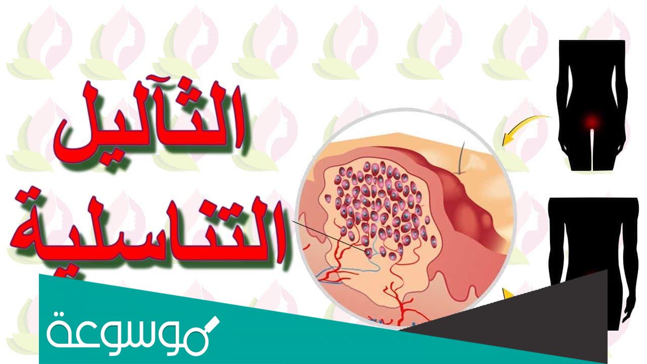 كيف أعرف أن الثالول التناسلي مات