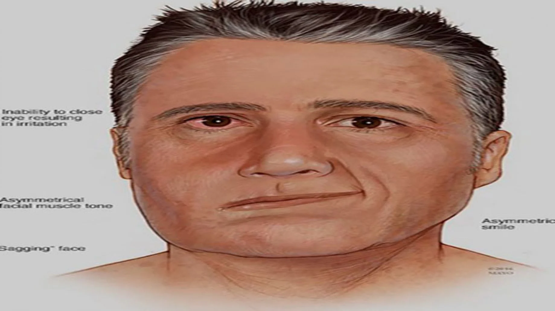 ما هي متلازمة رامسي هانت