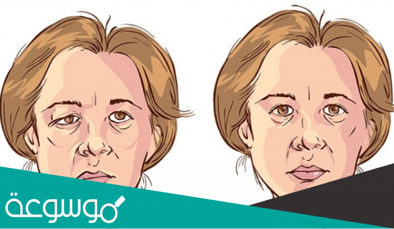 ما هي متلازمة رامسي هانت