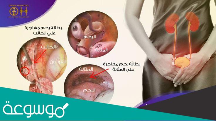 هل تظهر بطانة الرحم المهاجرة في الاشعة بالصبغة؟