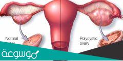 هل يحدث حمل مع تكيس المبايض
