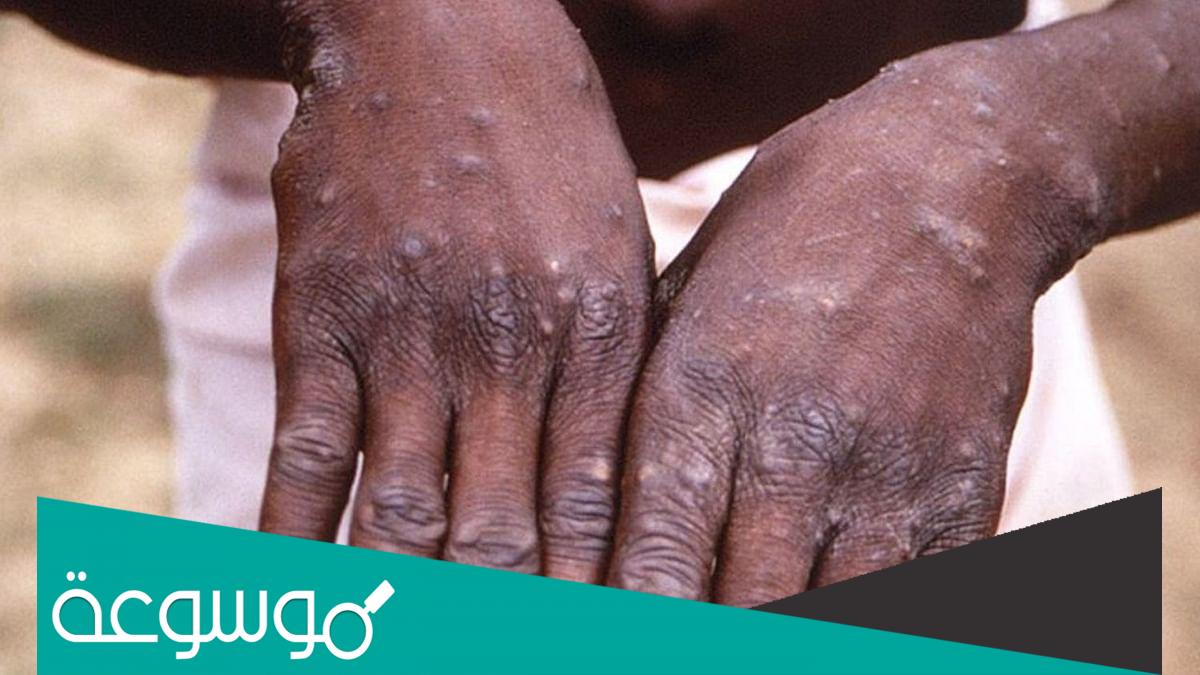 تفاصيل تسجيل أول إصابة بجدري القرود في السودان