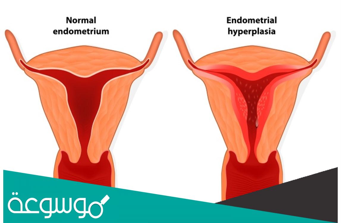 كم تكلفة عملية بطانة الرحم المهاجرة