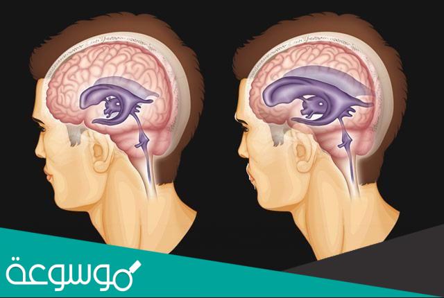 هل يعيش طفل الاستسقاء الدماغي طبيعي؟