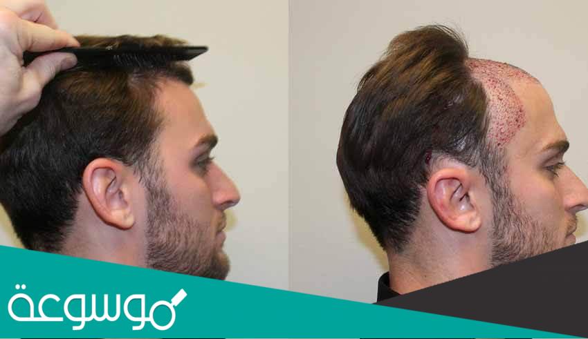 زراعة الشعر في تركيا 2022 معلومات تفصيلية