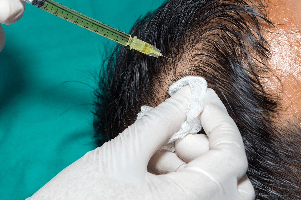 تجربتي مع زراعة الشعر في السعودية 2023