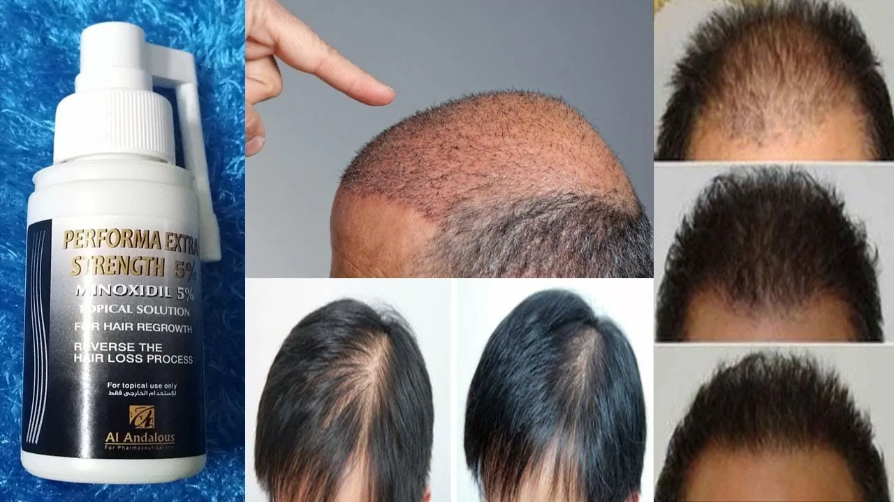 تجربتي مع بخاخ minoxidil للشعر