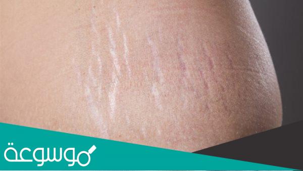 ما هو استرتش ماركس